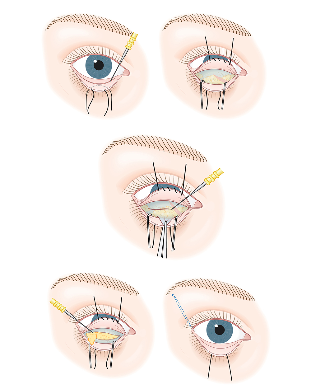 Best Blepharoplasty Surgery in Mumbai, eyelid Treatment at Affordable Price Cost India by Dr Debraj Shome at The Esthetic Clinics Best Blepharoplasty Surgery in Mumbai, eyelid Treatment at Affordable Price Cost India by Dr Debraj Shome at The Esthetic Clinics