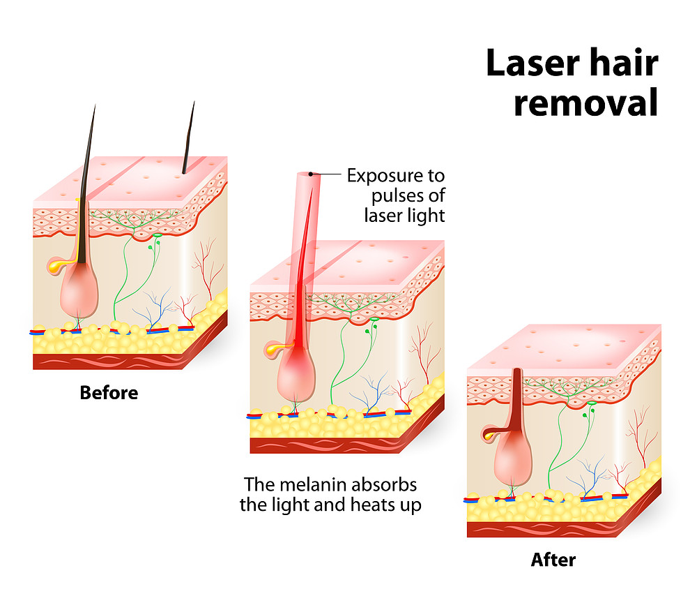 Best Laser Hair Removal Treatment in Mumbai at Affordable Price Cost India by Dr Rinky Kapoor at The Esthetic Clinics Best Laser Hair Removal Treatment in Mumbai at Affordable Price Cost India by Dr Rinky Kapoor at The Esthetic Clinics