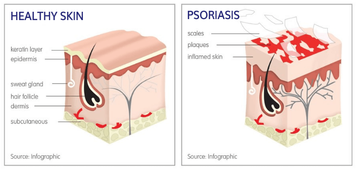 Best Psoriasis Treatment in Mumbai at Affordable Price Cost India by Dr Rinky Kapoor at The Esthetic Clinics Best Psoriasis Treatment in Mumbai at Affordable Price Cost India by Dr Rinky Kapoor at The Esthetic Clinics